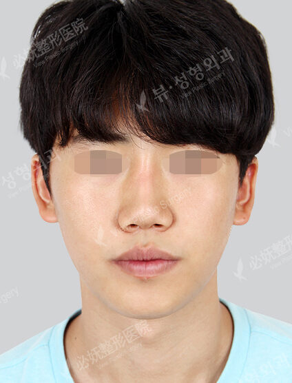 Nano Two Jaw+Natural Vline (6 Months) — After
