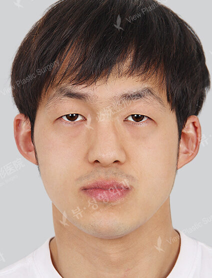 Nano Two Jaw+Natural Vline+Angular Jaw+Combination Ptosis Correction Surgery+Anterior Cheekbones Implant(6 Months) — Before