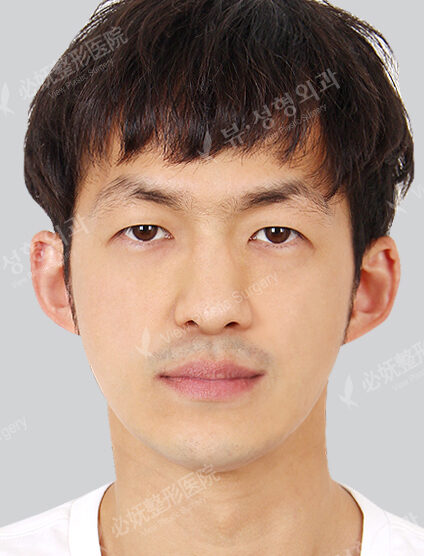 Nano Two Jaw+Natural Vline+Angular Jaw+Combination Ptosis Correction Surgery+Anterior Cheekbones Implant(6 Months) — After