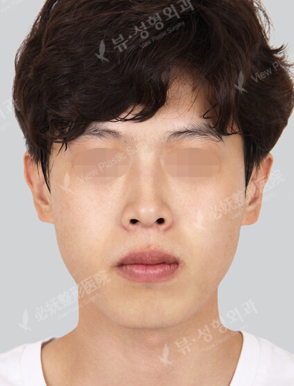 Nano Two Jaw+Natural Vline+Zygoma Reduction (6 Months) — Before