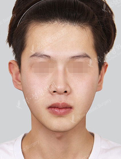 Nano Two Jaw+Natural Vline+Zygoma Reduction (6 Months) — After