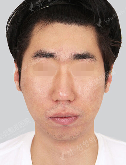 Nano Two Jaw+Natural Vline (11 Months) — Before