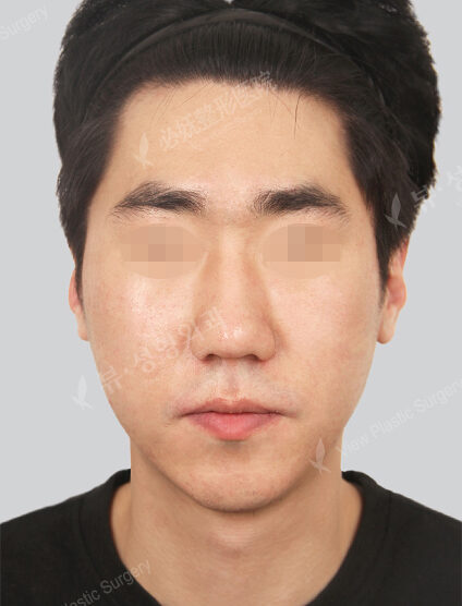 Nano Two Jaw+Natural Vline (11 Months) — After