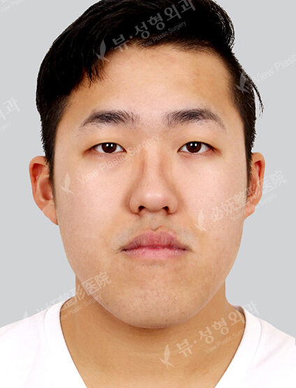 Nano Two Jaw+Natural Vline (1 Months) — Before