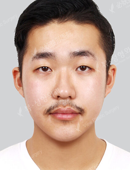 Nano Two Jaw+Natural Vline (1 Months) — After