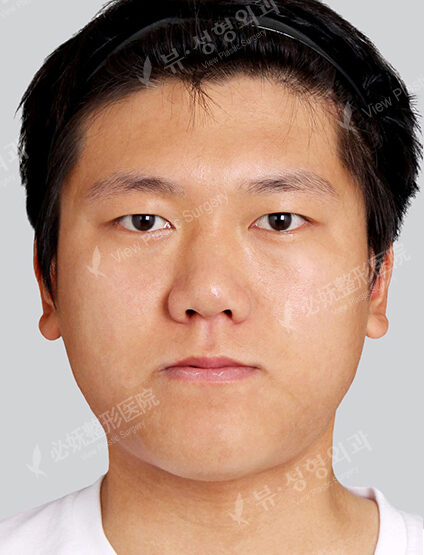 Nano Two Jaw+Natural Vline+Anterior Cheekbones Implant +T.O.P Surgery+Ptosis+Forehead Implant (1 Year 3 Months) — Before