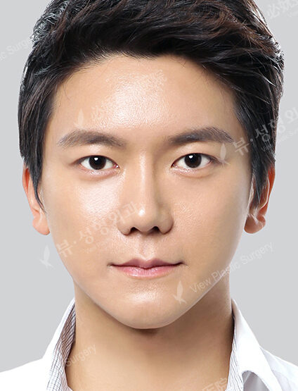 Nano Two Jaw+Natural Vline+Anterior Cheekbones Implant +T.O.P Surgery+Ptosis+Forehead Implant (1 Year 3 Months) — After