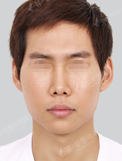 Natural Vline+Zygoma Reduction (3 Months) — Before