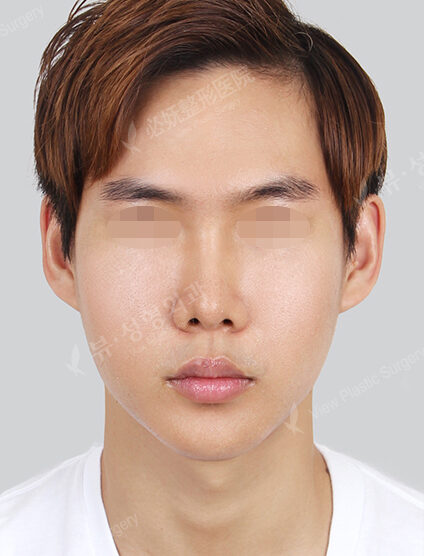 Natural Vline+Zygoma Reduction (3 Months) — After