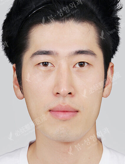 Nano Two Jaw+Natural Vline+Zygoma Reduction+Forehead Implant+T.O.P Surgery (11 Months) — Before