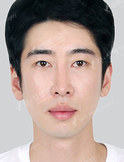 Nano Two Jaw+Natural Vline+Zygoma Reduction+Forehead Implant+T.O.P Surgery (11 Months) — After
