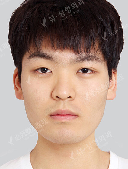 Natural Vline+Zygoma Reduction+Forehead Fat Graft+T.O.P Surgery+Fat Graft (7 Months) — Before