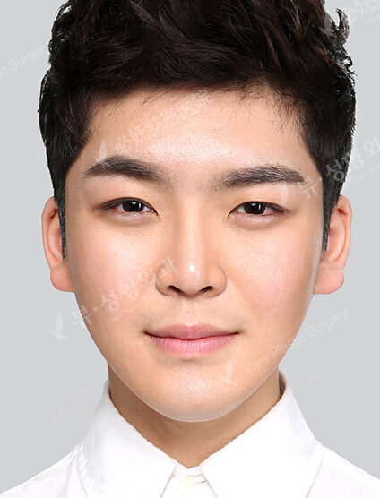 Natural Vline+Zygoma Reduction+Forehead Fat Graft+T.O.P Surgery+Fat Graft (7 Months) — After