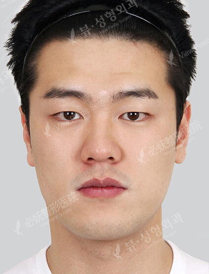 Nano Two Jaw+Natural Vline+Forehead Implant+T.O.P Surgery+Fat Graft (4 Months) — Before