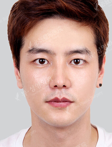 Nano Two Jaw+Natural Vline+Forehead Implant+T.O.P Surgery+Fat Graft (4 Months) — After