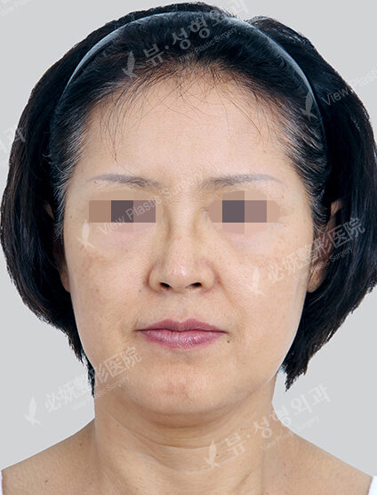 TESS Lifting+Fat Graft (1 Months) — Before