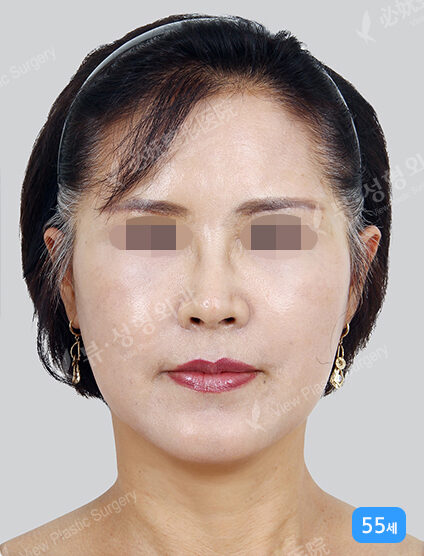 TESS Lifting+Fat Graft (1 Months) — After