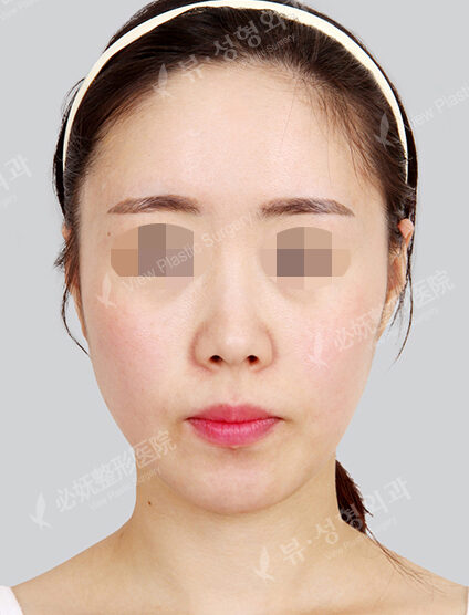 Endotine (1 Months) — Before