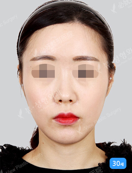 Endotine (1 Months) — After