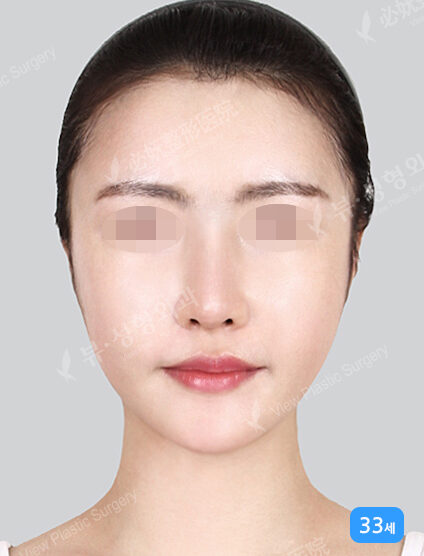 Acculifting (Cheeks , ChinLine)+ Nano Two Jaw+Natural Vline+Zygoma Reduction (Revisional Surgery) (4 Months) — After