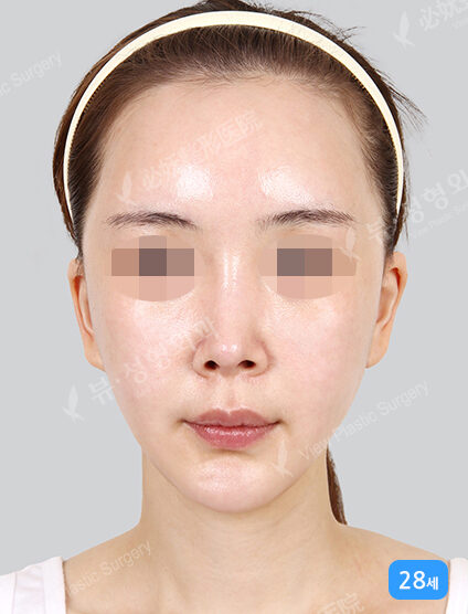 TESS Lifting+Zygoma Reduction (1 Months) — After