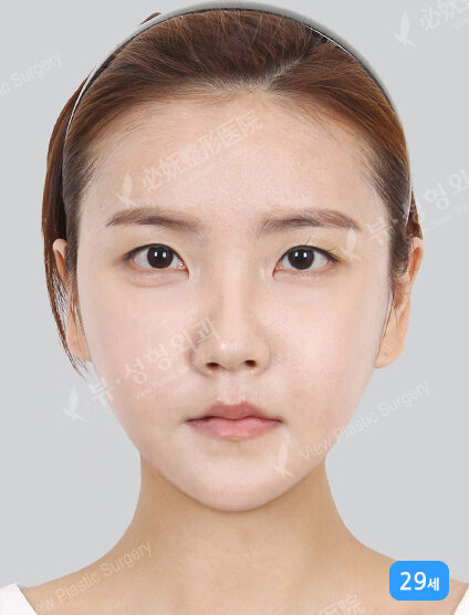 Acculifting+TESS Lifting+Natural Vline+Zygoma Reduction (1 Months) — After
