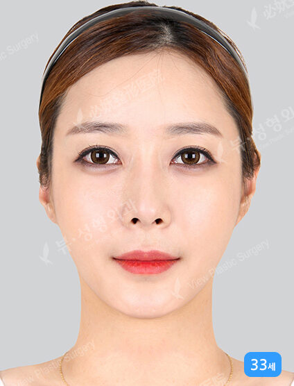 Acculifting (Cheeks , Double Chin)+ Nasolabial Filler (2 Months) — After