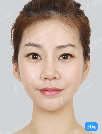 Omega Lifting+Nano Two Jaw+Natural Vline+Zygoma Reduction (5 Months) — After