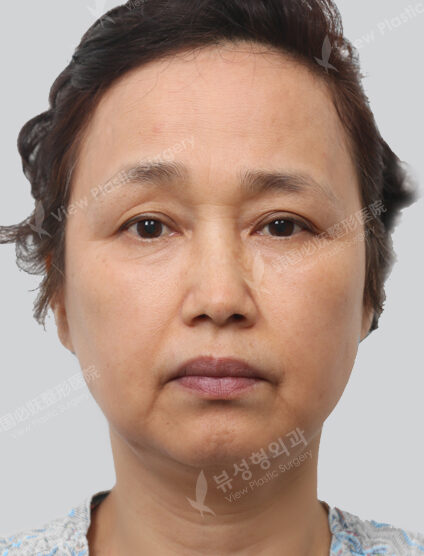 Thread Lifting+Acculift+Double Chin Liposuction (3 Months) — Before