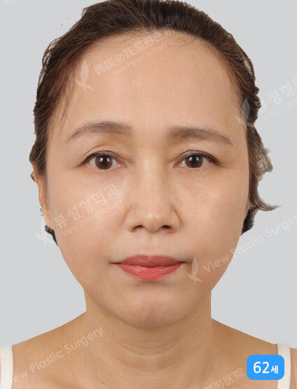 Thread Lifting+Acculift+Double Chin Liposuction (3 Months) — After