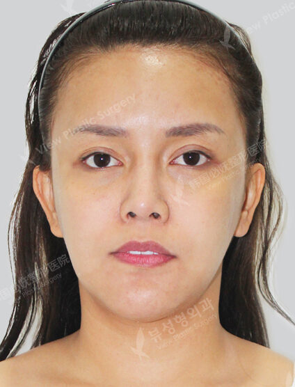 Face Lift (3 Months) — Before