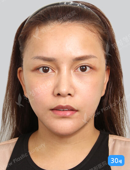Face Lift (3 Months) — After