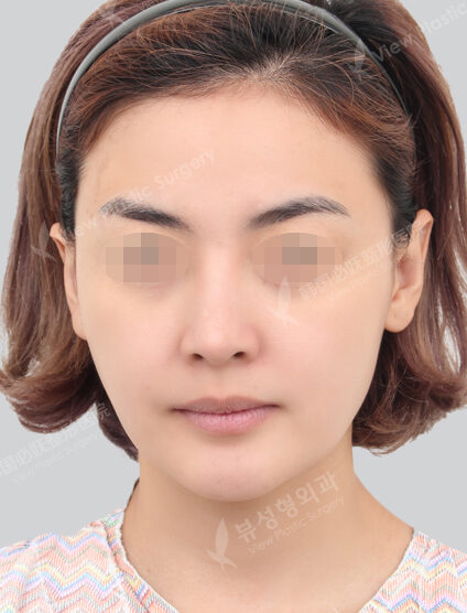 Smart Lifting+Acculift (ChinLine)+ Botox (3 Months) — Before