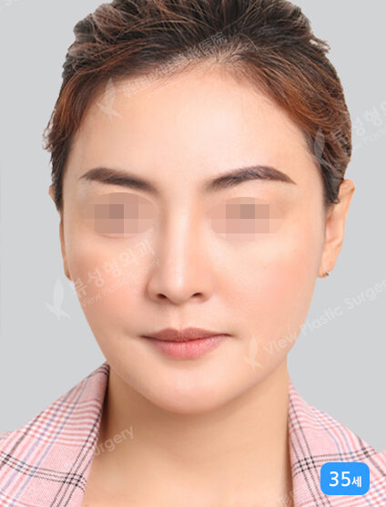 Smart Lifting+Acculift (ChinLine)+ Botox (3 Months) — After
