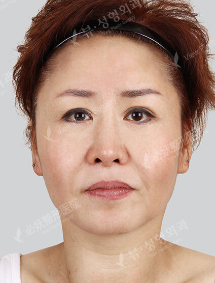 Smart Lifting+Natural Vline+Zygoma Reduction+PA — Before