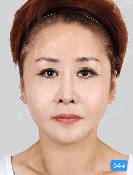 Smart Lifting+Natural Vline+Zygoma Reduction+PA — After