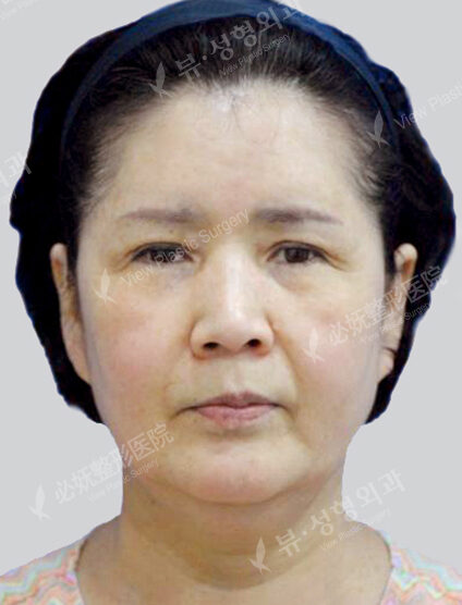 Face Lift+Endotine+Ptosis Correction (3 Months) — Before