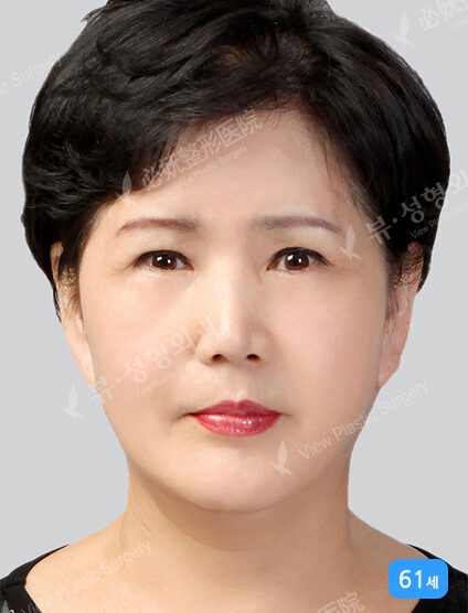 Face Lift+Endotine+Ptosis Correction (3 Months) — After