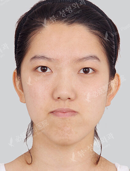 TESS Lifting+Nano Two Jaw+Natural Vline+Zygoma Reduction+Forehead Implant (3 Months) — Before