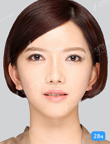TESS Lifting+Nano Two Jaw+Natural Vline+Zygoma Reduction+Forehead Implant (3 Months) — After