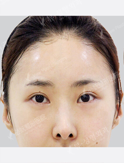Forehead Fat Graft(2 Months) — Before
