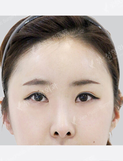 Forehead Fat Graft(2 Months) — After