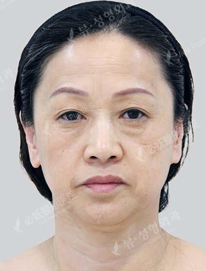 Face Lift+Lower Blepharoplasty (3 Months) — Before
