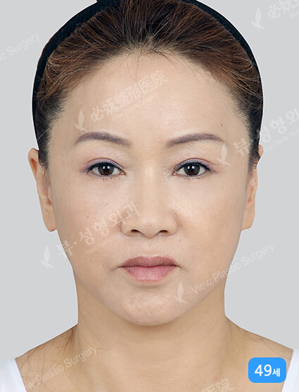 Face Lift+Lower Blepharoplasty (3 Months) — After