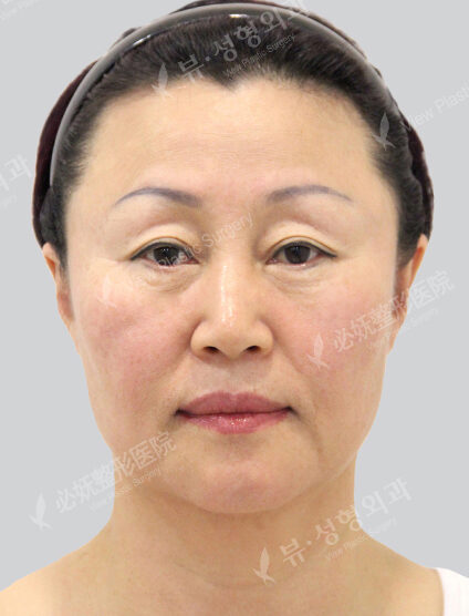 Face Lift+Endotine+Lower Blepharoplasty+Fat Graft (2 Months) — Before
