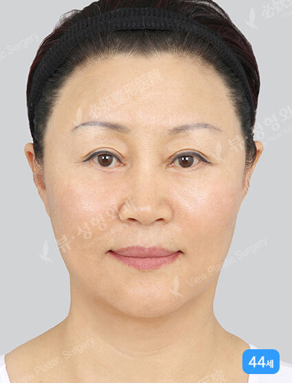 Face Lift+Endotine+Lower Blepharoplasty+Fat Graft (2 Months) — After