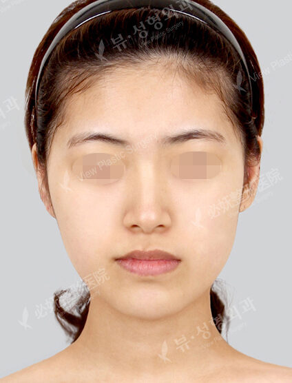 Forehead ,Frontal Cheeks Fat Graft(2 Months) — Before