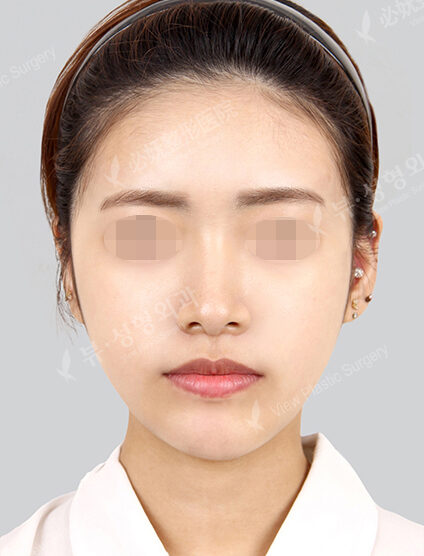 Forehead ,Frontal Cheeks Fat Graft(2 Months) — After
