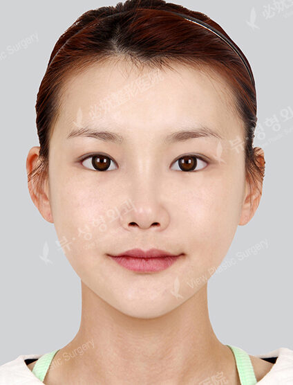 FaceFat Graft — After