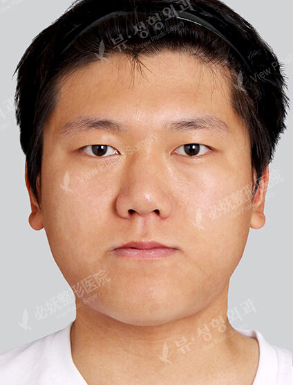 Acculifting+Nano Two Jaw+Natural Vline+Anterior Cheekbones Implant +T.O.P Surgery+Ptosis+Forehead Implant (1 Year 3 Months) — Before